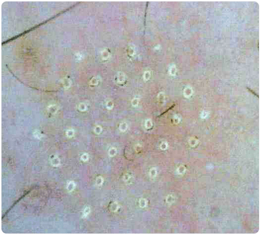 pielea la microscop după întinerirea fracționată