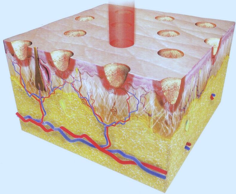 termoliză laser fracționată