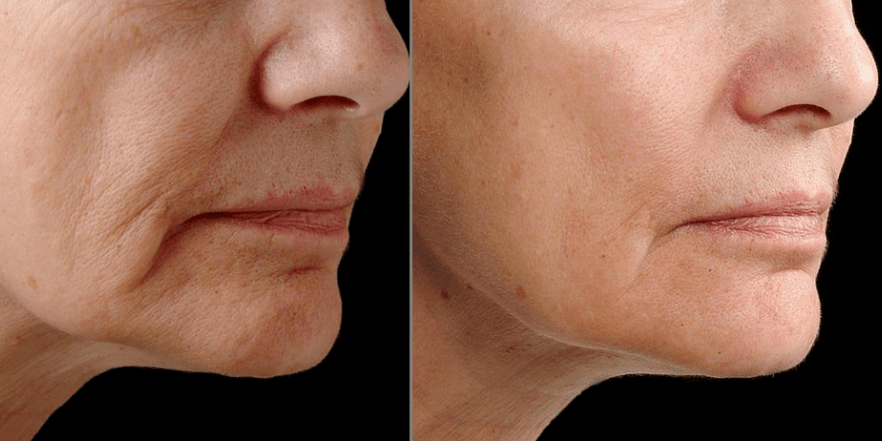 Rejuvenarea fracțională laser - efect