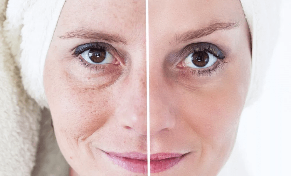 întinerire facială cu laser